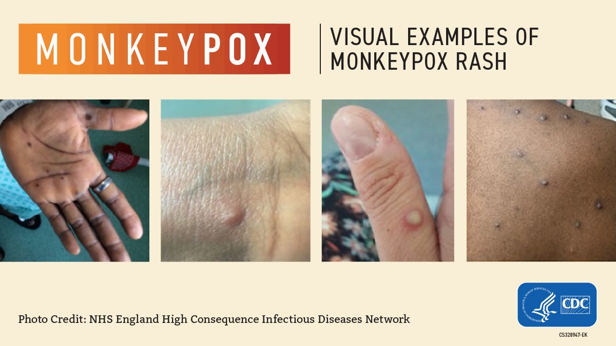 Claremont Colonic Monkeypox